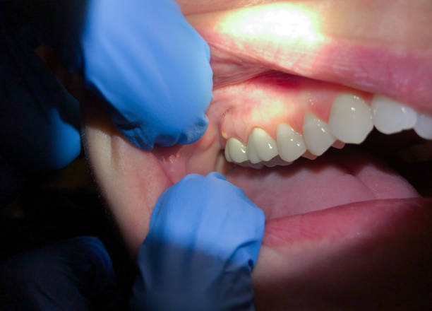 Best Emergency Tooth Extraction in Lower Lake, CA